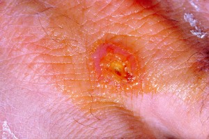 Tularie-infectie